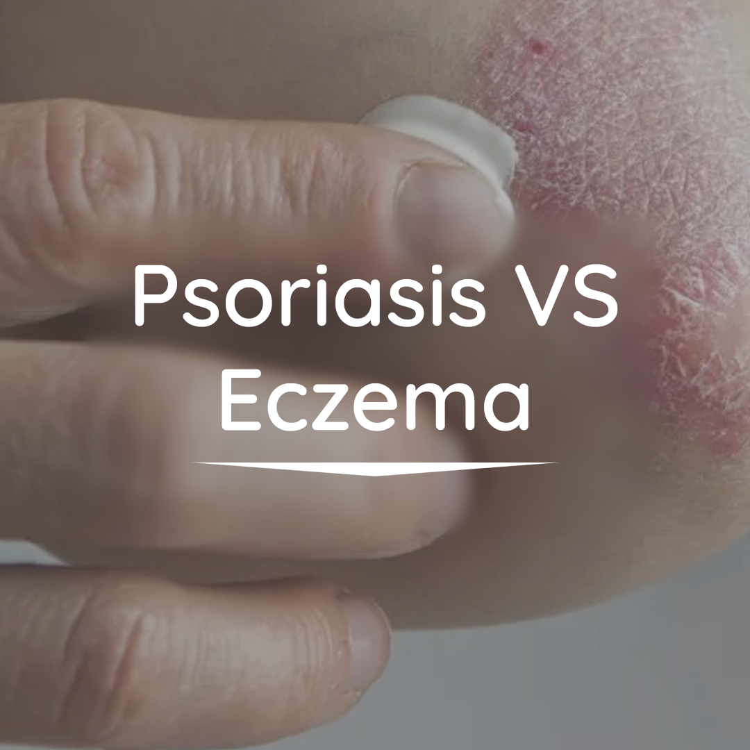 Eczema VS Psoriasis