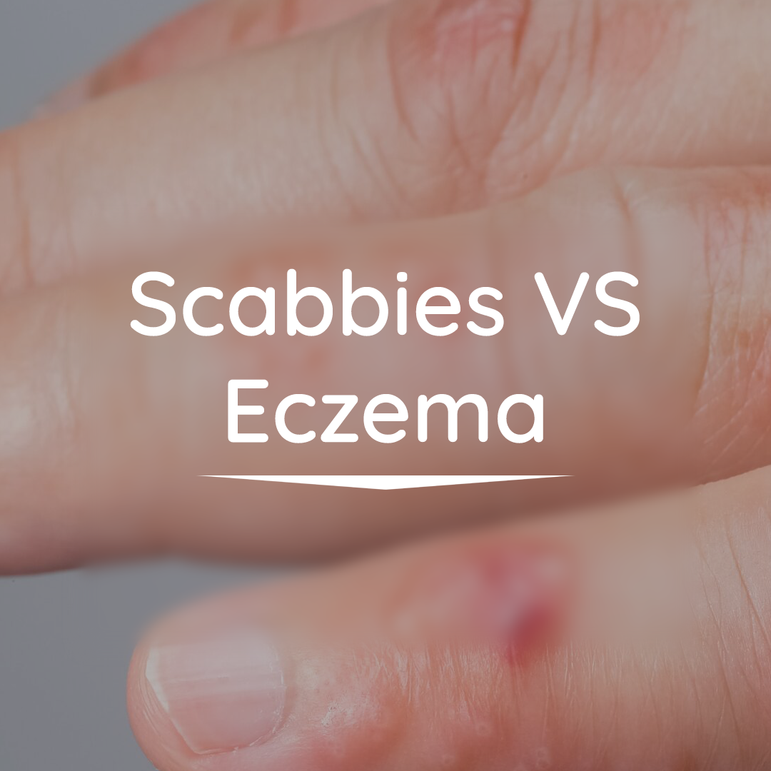 Eczema VS Scabbies