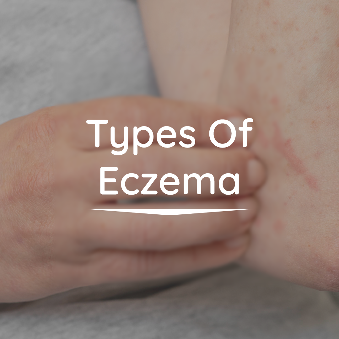 The Different Kinds Of Eczema